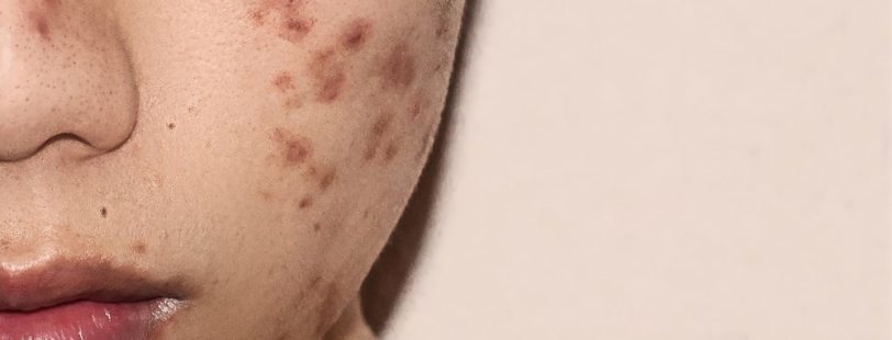 models-with-acne